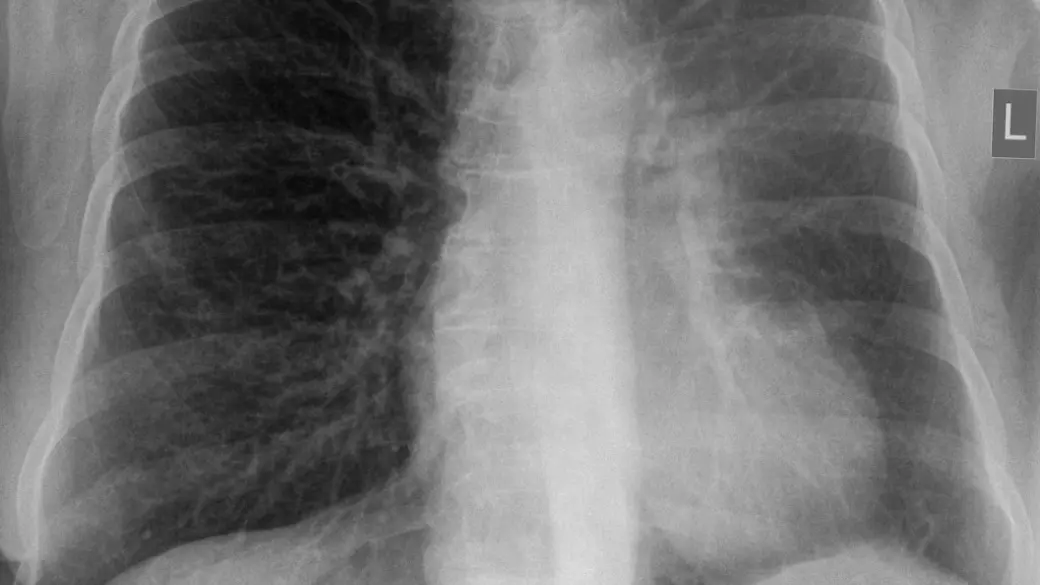 Atelectasis: What It Means on a Chest X-ray or CT, Causes, and Treatment