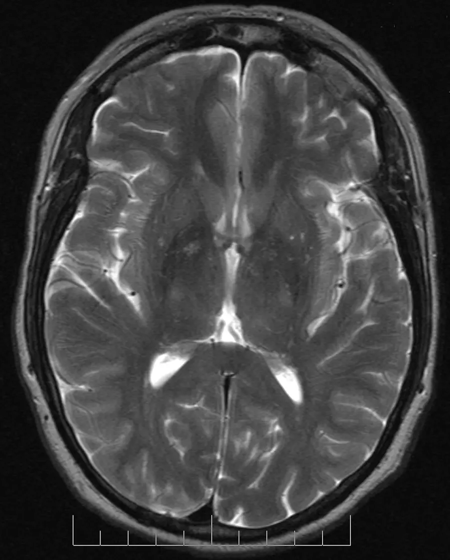 Brain MRI Second Opinion