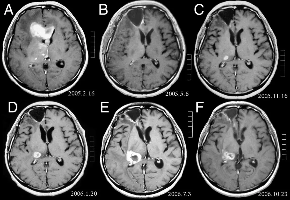 Can an MRI Detect Cancer?