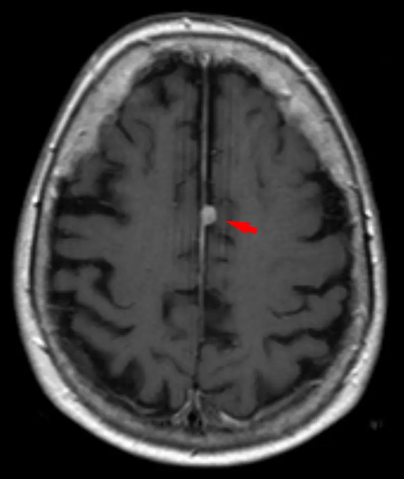 Can MRI Detect All Tumors?