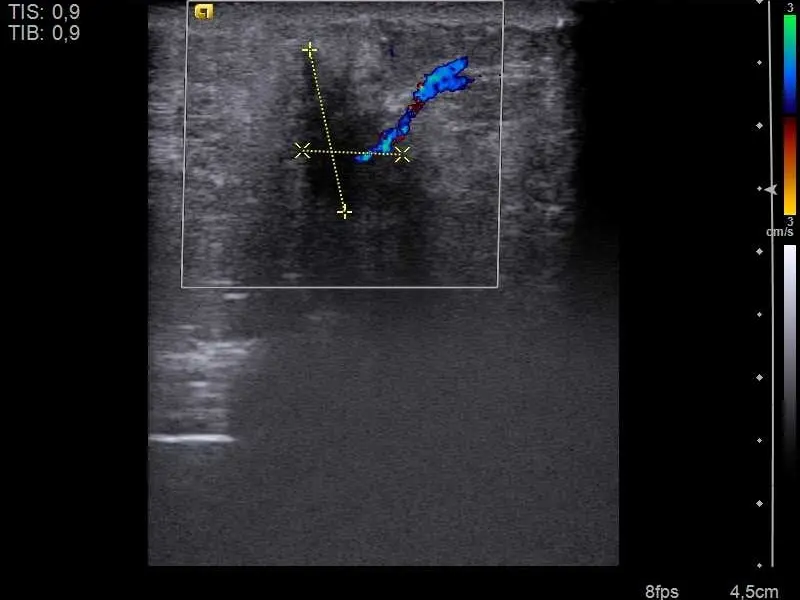 Can Ultrasound Detect Cancer?