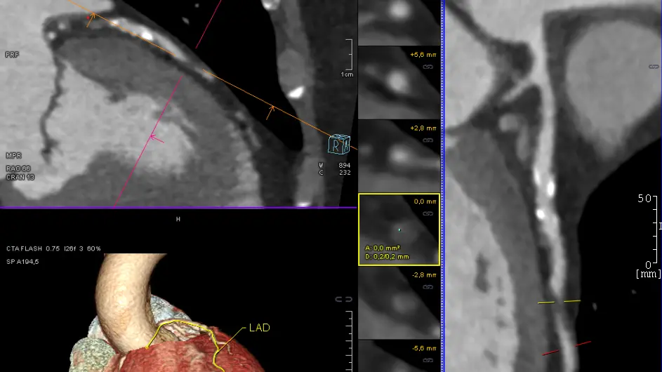 Cardiac CT Second Opinion