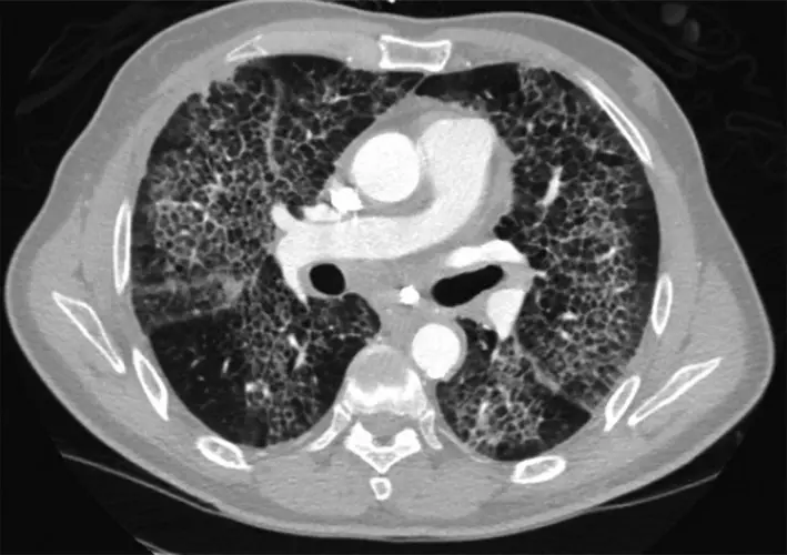 What Does "Crazy Paving" Mean in a Radiology Report?