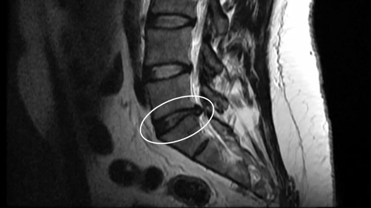 Does a Herniated Disc Always Cause Back Pain?