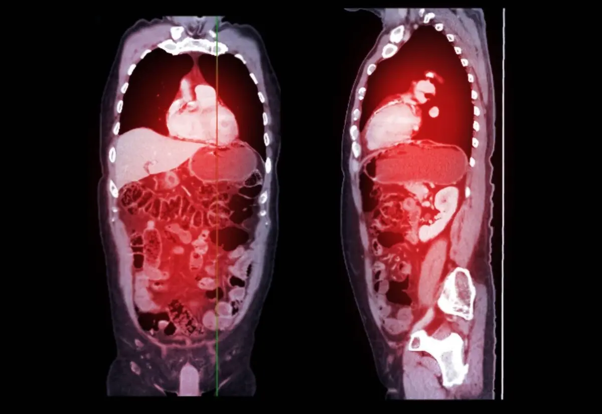 What Does "Fat Stranding" Mean in a Radiology Report?