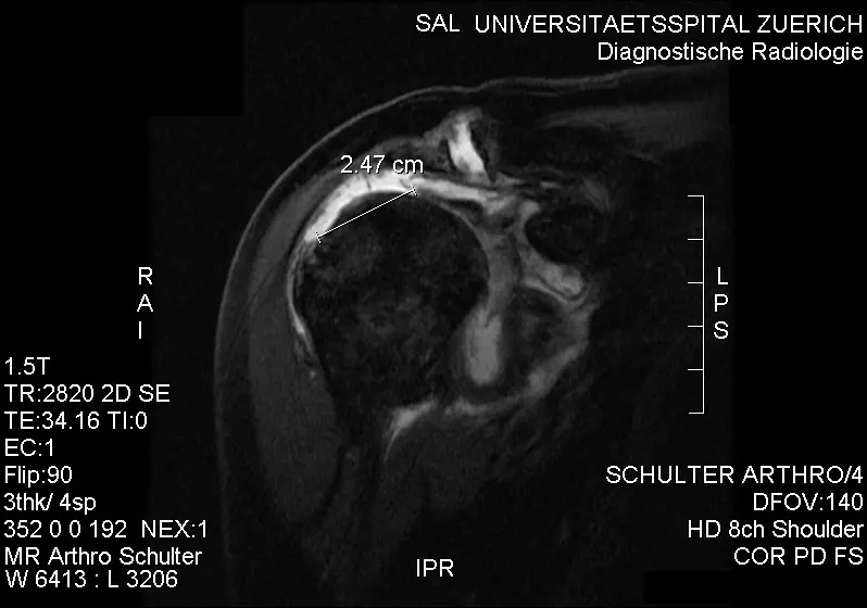 Shoulder MRI Second Opinion