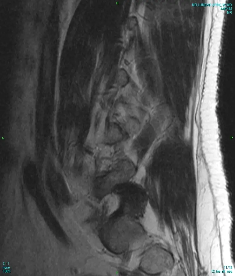 Spine MRI Second Opinion: Lumbar, Cervical and Thoracic