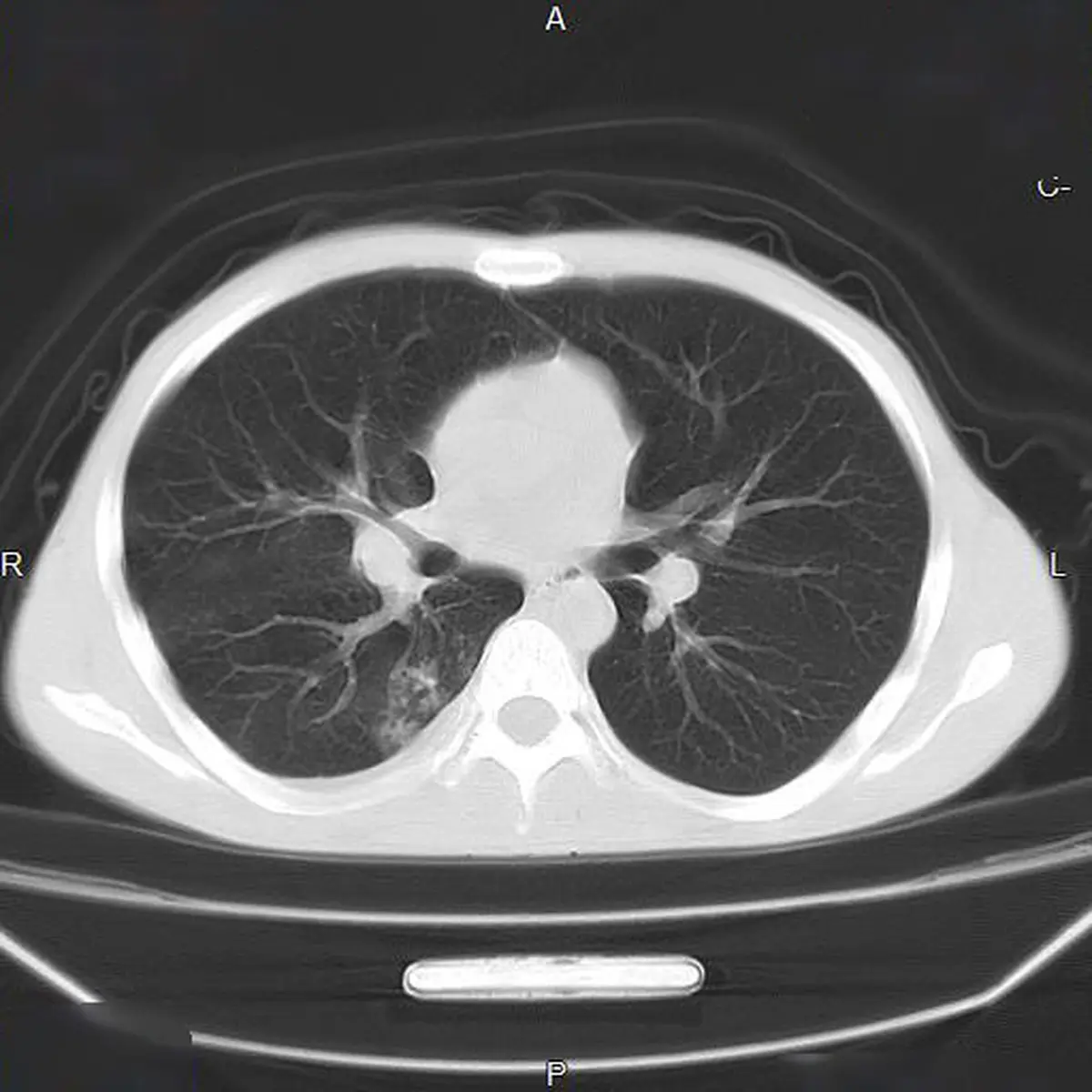 What Does "Tree-in-Bud" Mean in a Radiology Report?