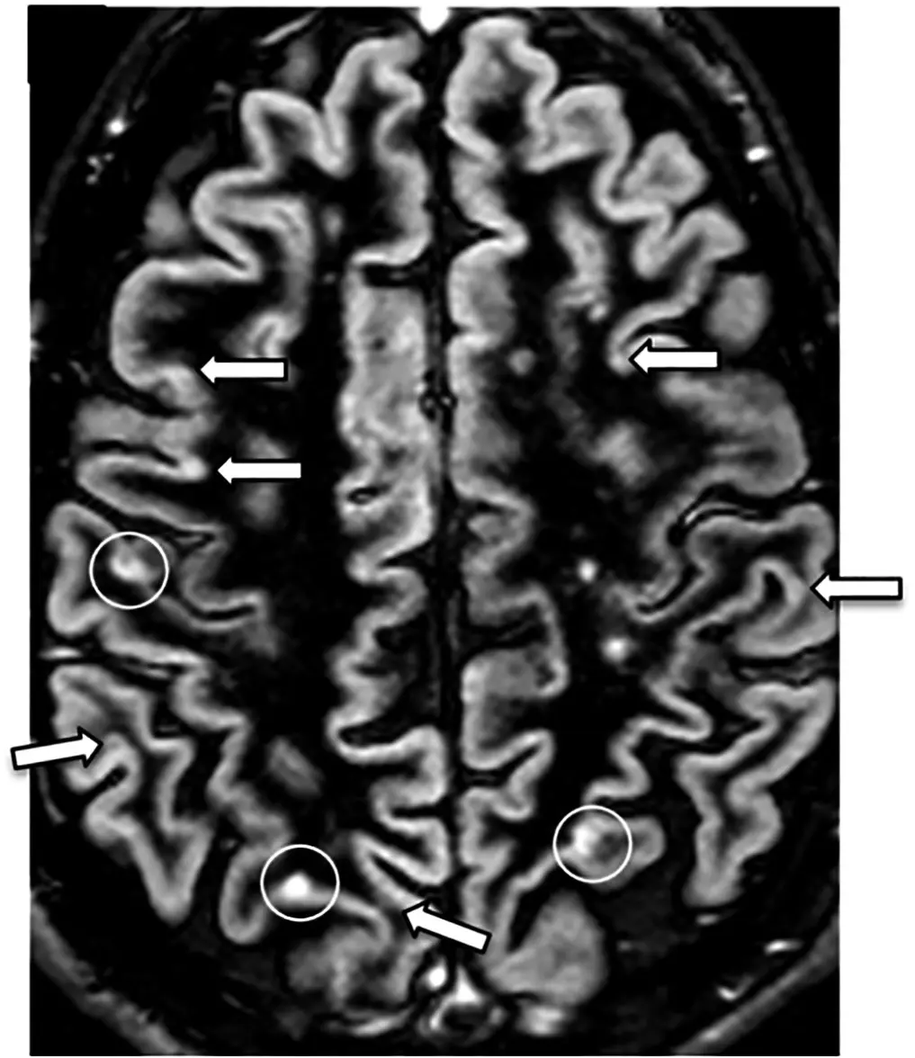 What Does a Lesion on an MRI Mean?