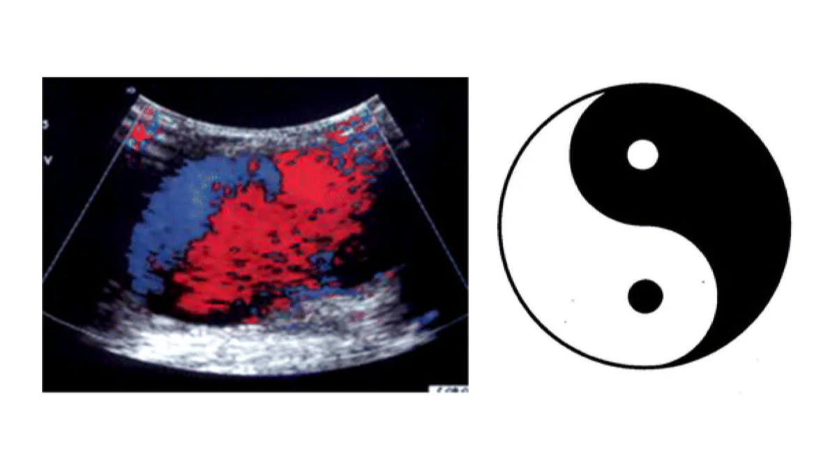 What Does "Yin-Yang Sign" Mean in a Radiology Report?