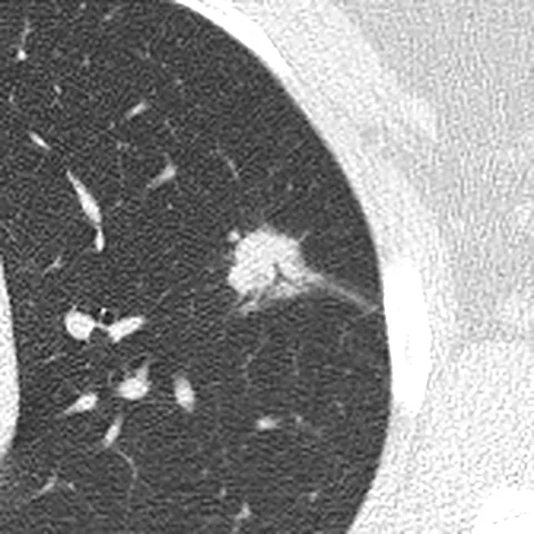 Axial chest CT in a lung window. An 18 mm nodule with spiky edges in the left upper lobe is outlined in green.