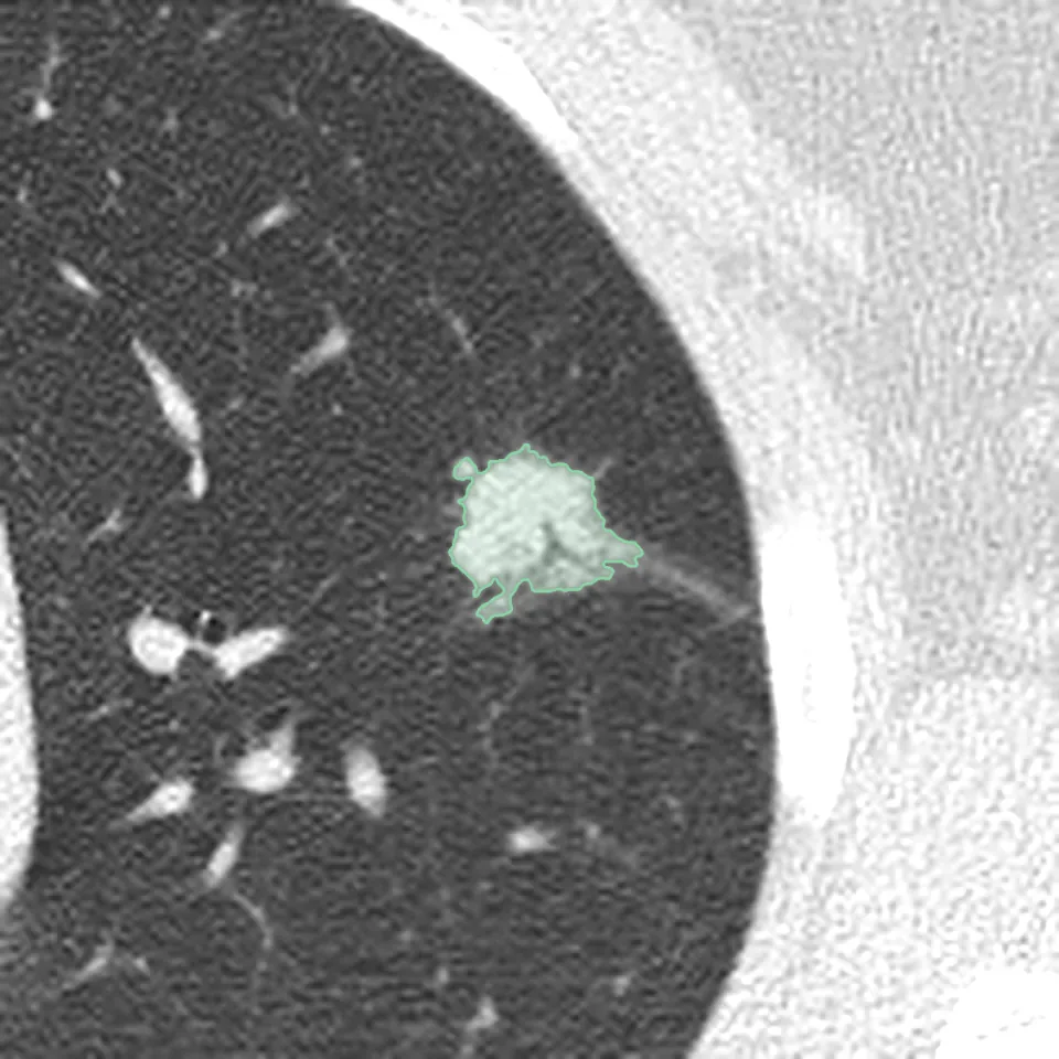 Axial slice, lung window: the 18 × 15 mm nodule in the left upper lobe, outlined.