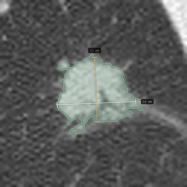 Magnified: the nodule's long axis (18 mm) and short axis (15 mm).