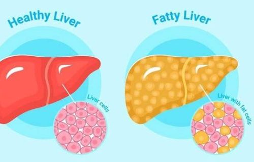 fatty liver